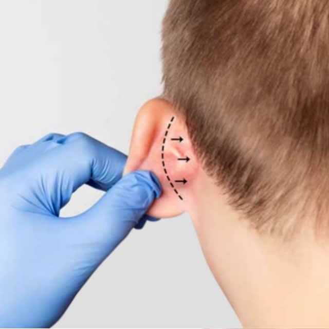 RINOPLASTIA-ULTRASONICA-GUAYAQUIL